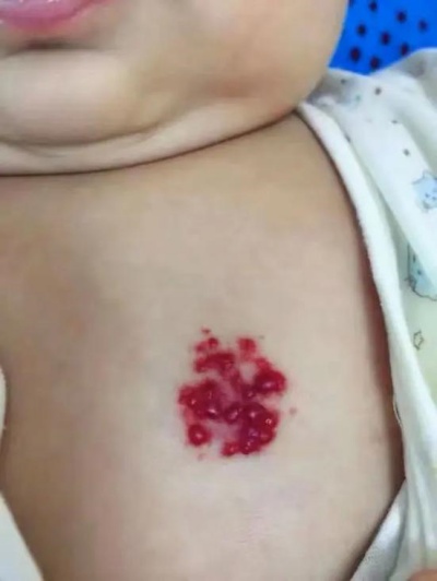 婴儿血管瘤和红色胎记怎么区别？